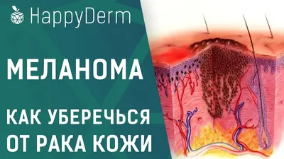 Меланома кожи - симптомы, диагностика и методы лечения. - YouTube