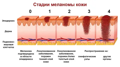 Меланома кожи: стадии, фото и процедура лечения. Онкология