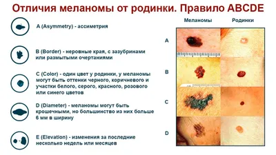 Меланома кожи: стадии, фото и процедура лечения. Онкология