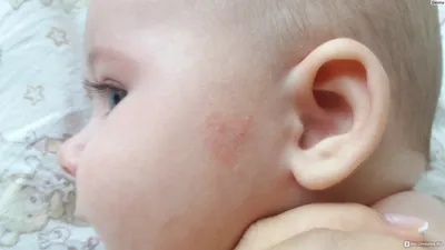 Аллергия У Месячного Ребенка – Telegraph