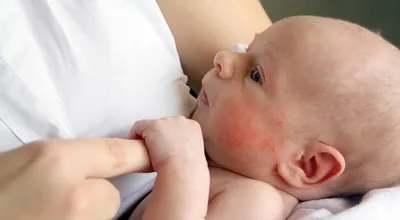 Аллергия У Месячного Ребенка – Telegraph