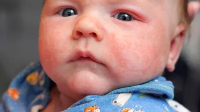 Аллергия У 2 Месячного Ребенка – Telegraph