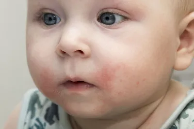Аллергия У 2 Месячного Ребенка – Telegraph