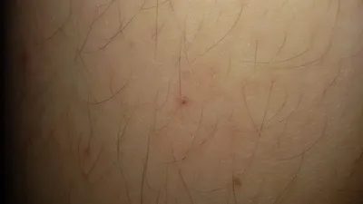 Красные точки как от укола по телу - Вопрос дерматологу - 03 Онлайн