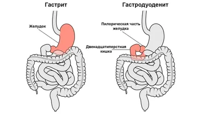 Хронический гастродуоденит у взрослых: лечение, симптомы, рекомендации