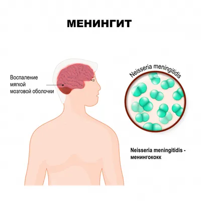 Менингит - причины появления, симптомы заболевания, диагностика и способы  лечения
