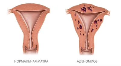 Аденомиоз матки: причины, симптомы, диагностика, лечение