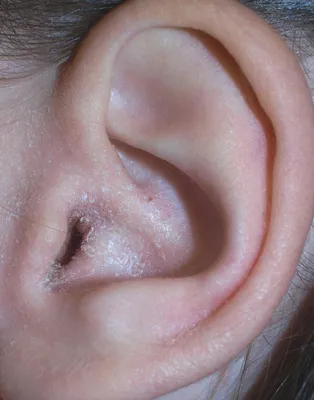 Заболевания наружного уха - Экзема ушной раковины или наружного слухового  прохода, лечение в Москве