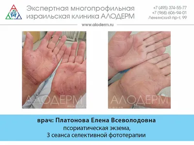 Лечение экземы фототерапией в Москве | Клиника АЛОДЕРМ , Москва