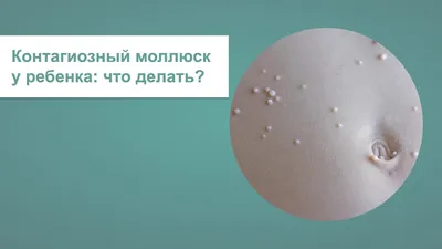 Контагиозный моллюск у ребенка: что делать? | Журнал Доктора Комаровського