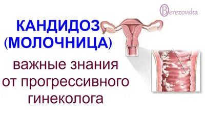 Кандидоз (молочница) | Доктор Елена Березовская