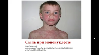 Инфекционный мононуклеоз Кафедра детских инфекционных болезней - YouTube