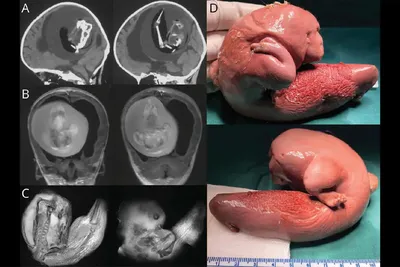 Врачи из Китая извлекли из мозга годовалой девочки плод ее близнеца -  Газета.Ru | Новости