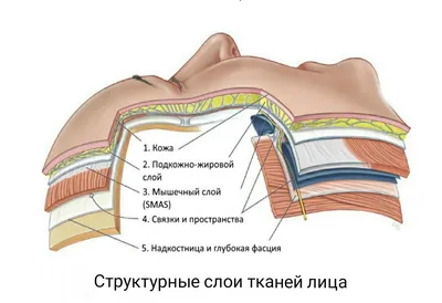 Методика инъекции нейротоксинов для коррекции глабеллярных (межбровных)  морщин