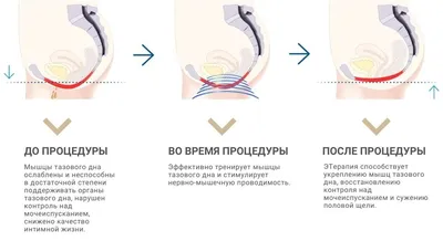 Упражнения для укрепления мышц тазового дна. Обсуждение на LiveInternet -  Российский Сервис Онлайн-Дневников | Упражнения, Здоровье, Мышцы