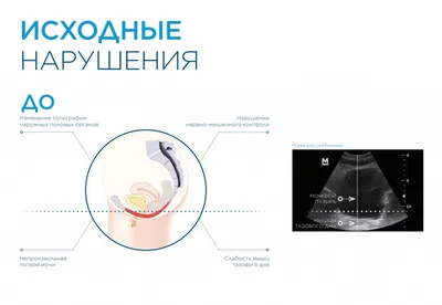 От недержания до газов. Зачем надо тренировать мышцы тазового дна? |  Здоровая жизнь | Здоровье | Аргументы и Факты