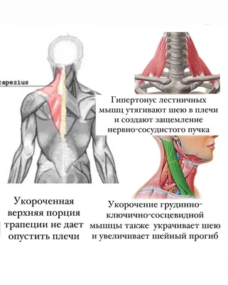 Фитнес тренер - Спазм трапеции, или зачем знать функцию... | Facebook