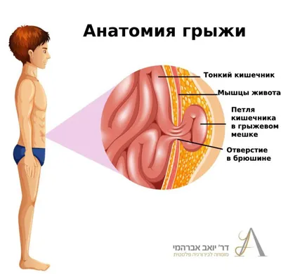 Диастаз мышц: что это такое и как с этим бороться