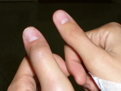 На фаланге пальца образовался шарик. Шишки на суставах пальцев рук:  лечение. Почему появляется шишка на кисти руки