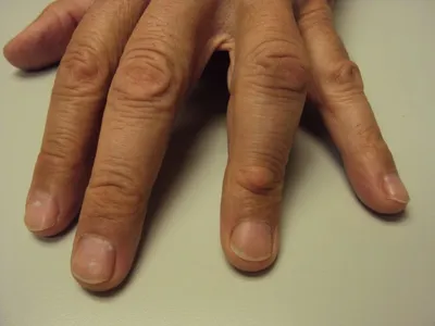 На фаланге пальца образовался шарик. Шишки на суставах пальцев рук:  лечение. Почему появляется шишка на кисти руки