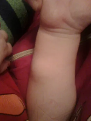 Плотная шишка на руке у ребенка - Вопрос детскому хирургу - 03 Онлайн