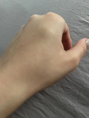 Шишка на кисти руки, болезненность при нажатии - Вопрос хирургу - 03 Онлайн