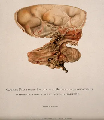 Мягкое небо, надгортанник и полости носа, проявляющиеся симптомами  гангрены. Хромолитография В. Гуммельта, ок. 1897.