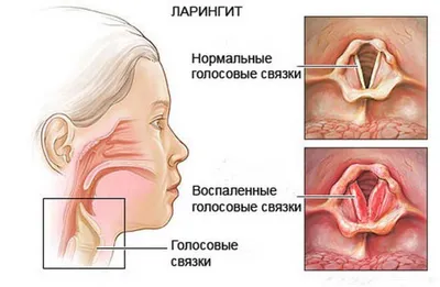 Ларингит. Его признаки и лечение