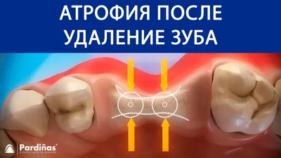 Атрофия после удаление зуба © - YouTube