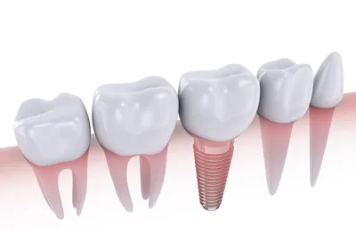 Что делать, если вы уже потеряли зуб или вам предстоит его удаление? | Блог  Кремлевской стоматологии