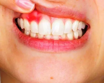 Периостит (воспаление надкостницы зуба) — причины, виды, 7 симптомов и  лечение |