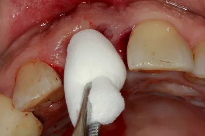 После удаления зуба торчит кость из десны: почему и что делать | elesto.ru