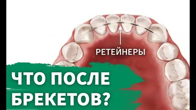 Что делать после снятия брекетов: что носят после удаления конструкции,  зачем нужны ретейнеры и капы и сколько времени с ними ходить? - Городская  клиническая стоматологическая поликлиника №1 г. Кемерово. | ГАУЗ КО «