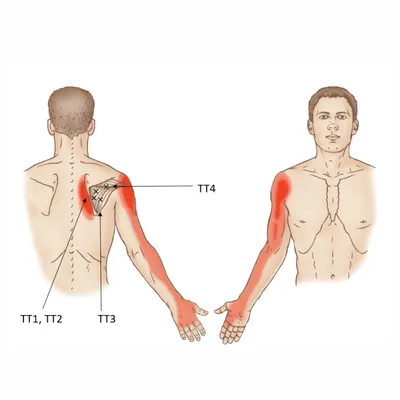 МАНУАЛЬНЫЙ МАССАЖ Нальчик on Instagram: \"СИНДРОМ ПОДОСТНОЙ МЫШЦЫ Подостная  мышца является одной из четырех мышц, которые образуют вращательную манжету  плеча -группа мышц и сухожилий, обеспечивающих поддержку плеча. Подостная  мышца имеет почти треугольную