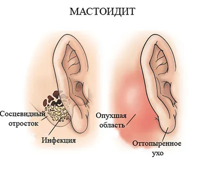 Отит - лечение в СПб, признаки, симптомы