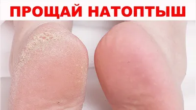 Натоптыши, сухие мозоли, трещины на пятках не дают покоя? 5 СУПЕР СПОСОБОВ  гарантированно помогут - YouTube