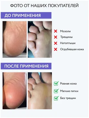 ARAVIA Professional Лосьон для удаления мозолей и натоптышей Liquid  Pedicure, 500 мл — купить в интернет-магазине по низкой цене на Яндекс  Маркете