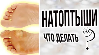 Как убрать натоптыши на ногах | DoctorRU