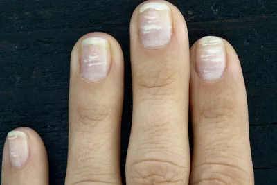Белые пятна на ногтях пальцев (53 фото)