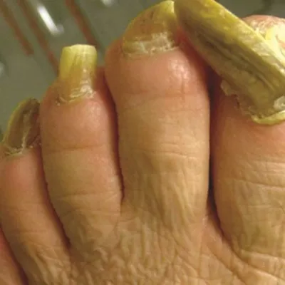 Признаки болезни по состоянию ногтей. Восточная медицина: О каких болезнях  можно узнать по ногтям. О чем рассказывает диагностика