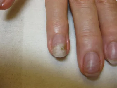 Заболевания ногтей: возможные причины, типы и профилактика