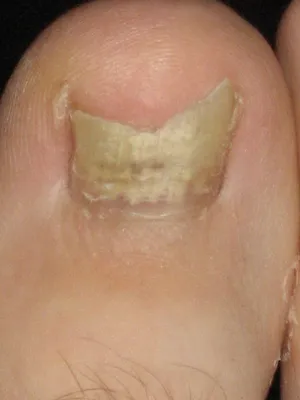 Негрибковые заболевания ногтей на ногах фотографии