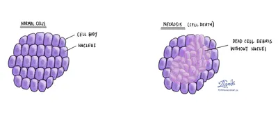 Некроз | Словарь патологии | MyPathologyReport.ca