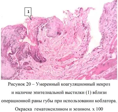 Рисунок 20 – Умеренный коагуляционный некроз и наличие эпителиальной  выстилки (1) вблизи операционной раны губы при использовании коблатора.  Окраска гематоксилином и эозином. х 100