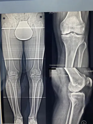 Асептический некроз медиального мыщелка бедренной кости.