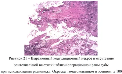 Рисунок 21 – Выраженный коагуляционный некроз и отсутствие эпителиальной  выстилки вблизи операционной раны губы при использовании радионожа. Окраска  гематоксилином и эозином. х 100