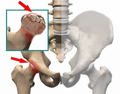 Асептический некроз головки бедренной кости