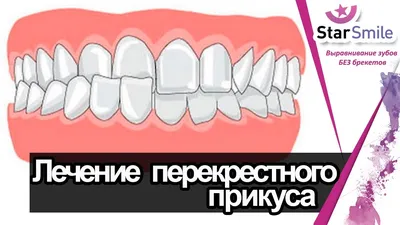 Неправильный прикус зубов у взрослых и детей - Как узнать и можно ли  исправить?