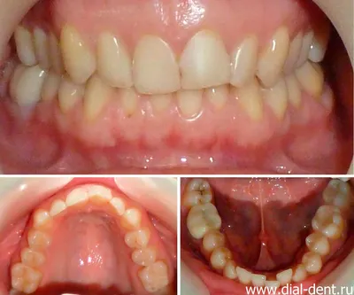 Исправление прикуса и протезирование передних зубов