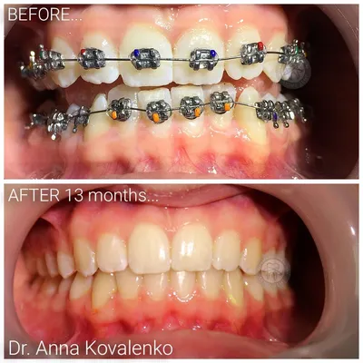 Нарушенный Прикус Зубов [До После Фото] Как Выглядит ЛюмиДент